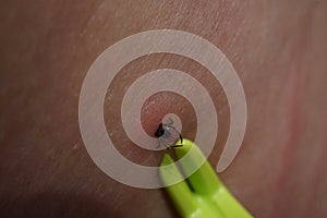 Removal of sucking tick, Ixodes ricinus, from human skin with yellow tweezers