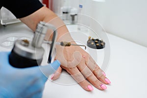 Removal of warts in dermatology clinic