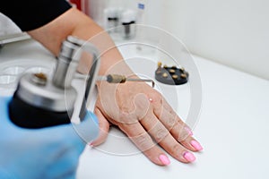 Removal of warts in dermatology clinic photo
