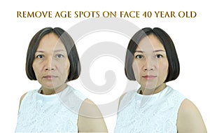 Before and after remove age