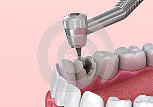 Removing the caries . Medically accurate tooth illustration