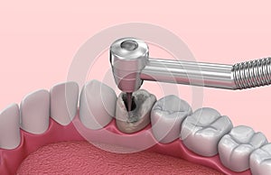 Removing the caries . Medically accurate tooth illustration