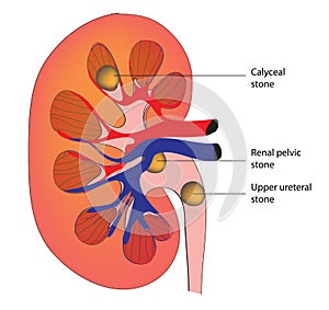 Renal calculi photo
