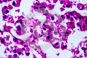 Renal cell carcinoma, light micrograph