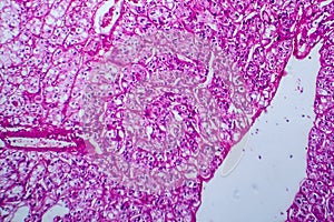 Renal cell carcinoma, light micrograph