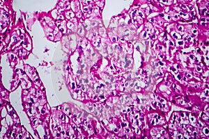 Renal cell carcinoma, light micrograph