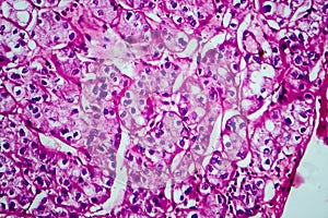 Renal cell carcinoma, light micrograph