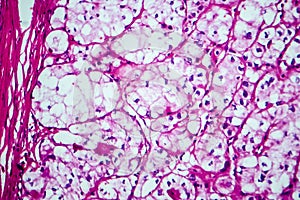 Renal cell carcinoma, light micrograph