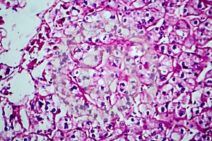 Renal cell carcinoma, light micrograph