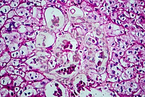 Renal cell carcinoma, light micrograph