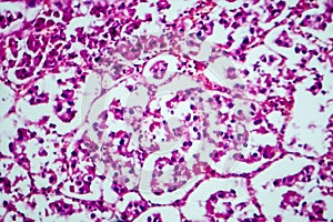 Renal cell carcinoma, light micrograph
