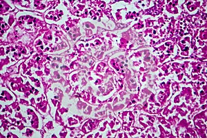 Renal cell carcinoma, light micrograph