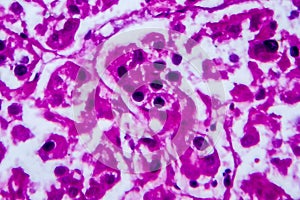 Renal cell carcinoma, light micrograph