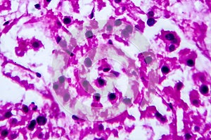 Renal cell carcinoma, light micrograph