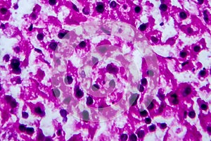 Renal cell carcinoma, light micrograph