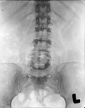 Renal pelvis spine xray (x-ray)