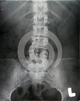 Renal pelvis spine xray (x-ray)