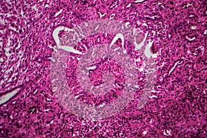 Renal tuberculosis, light micrograph