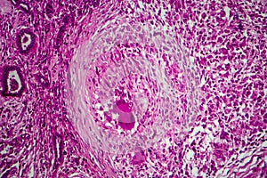 Renal tuberculosis, light micrograph