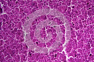 Renal tuberculosis, light micrograph