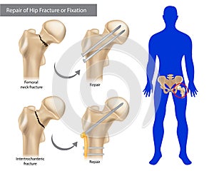 Repair of Hip Fracture or Fixation. Intertrochanteric fracture or Femoral neck fracture. photo