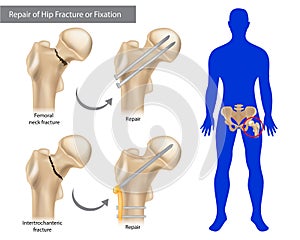 Repair of Hip Fracture or Fixation. Intertrochanteric fracture or Femoral neck fracture.