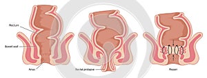 Repair of prolapsed rectum