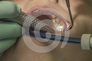 Repairing teeth