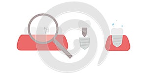 replacement of broken tooth with dental cap