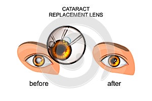 Replacement of the crystalline lens in cataract