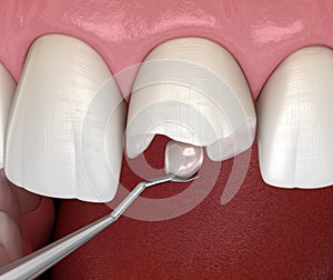 Restoration of broken tooth. Medically accurate 3D illustration