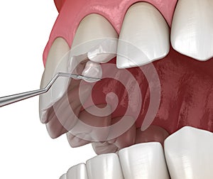 Restoration of broken tooth. Medically accurate 3D illustration