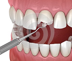 Restoration of broken tooth. Medically accurate 3D illustration