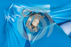 Restoration of the molar of a human tooth with filling material.