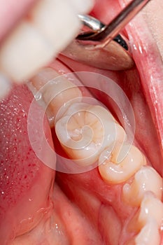 Restoration of the tooth with photopolymer filling close-up macro. Caries