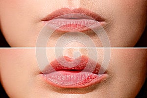 Result before and after lip shaping. A woman makes lip shape correction in a cosmetology clinic. Lip injections, lip