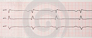 Results of cardiogram on sheet of paper