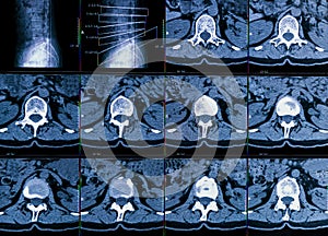 Results of computer tomography or CT imaging of human spine of a patient with chronic back pain, shows degenerative changes of