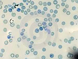 Reticulocyte count from blood smear Hematology.