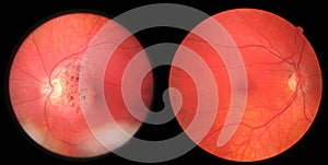 Retina - damaged and healthy