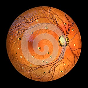 Retina in Ocular Histoplasmosis Syndrome, 3D illustration