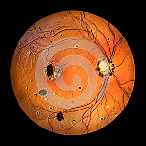 Retina in Ocular Histoplasmosis Syndrome, 3D illustration