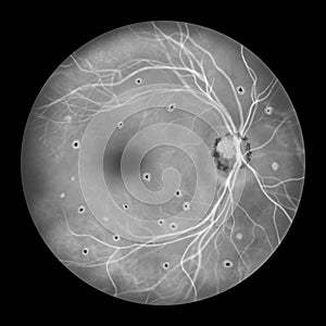 Retina in Ocular Histoplasmosis Syndrome, illustration