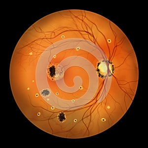 Retina in Ocular Histoplasmosis Syndrome, illustration