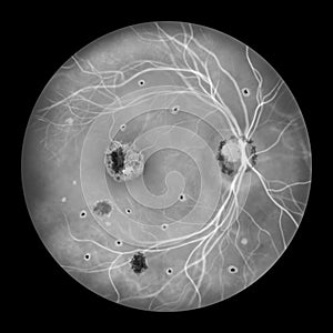 Retina in Ocular Histoplasmosis Syndrome, illustration