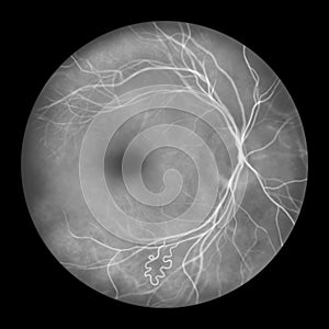 Retinal arteriovenous malformation, illustration