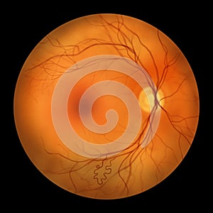 Retinal arteriovenous malformation, illustration