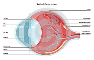 Retinal detachment. Emergency situation in which a thin layer of tissue