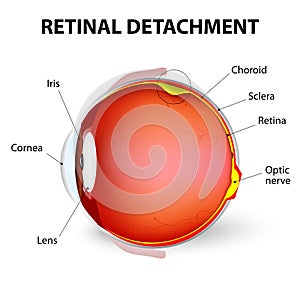 Retinal detachment. Vector diagram photo