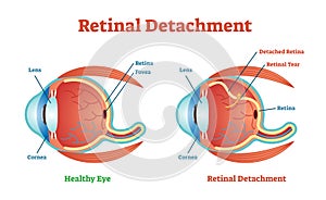 Retinal Detachment vector illustration diagram, anatomical scheme.